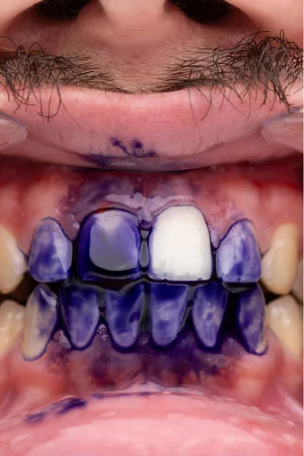 Pasta Morada BLANQUEADOR DENTAL 🦷